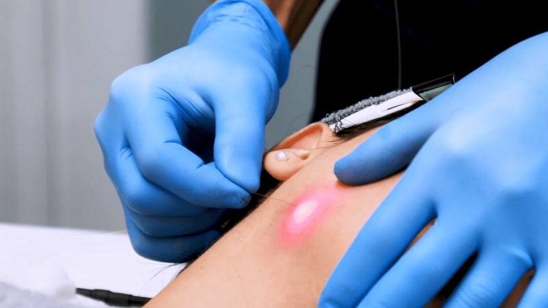 La nueva moda en estética que causa furor en Hollywood llega a Argentina